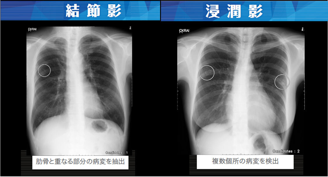 結節影、浸潤影